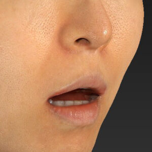 新宿ラクル美容外科クリニック　山本厚志　「外側人中短縮術（上口唇挙上術）修正 + 口角挙上（スマイルリフト）修正」　手術前　１２月１３日