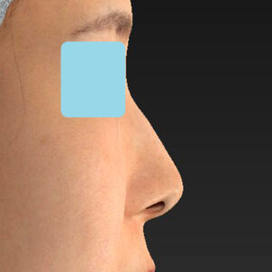 「鼻孔縁下降術」　新宿ラクル美容外科クリニック　山本厚志　３０代女性　手術前　１月３日