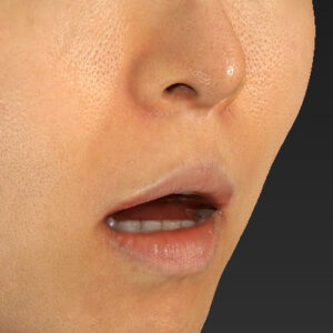 新宿ラクル美容外科クリニック　山本厚志　「外側人中短縮術（上口唇挙上術）修正 + 口角挙上（スマイルリフト）修正」　手術前　４月８日