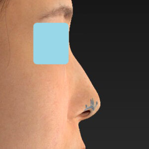 「鼻孔縁下降術」　新宿ラクル美容外科クリニック　山本厚志　３０代女性　デザイン　１月３日