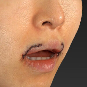 新宿ラクル美容外科クリニック　山本厚志　「外側人中短縮術（上口唇挙上術）修正 + 口角挙上（スマイルリフト）修正」　手術直後　１２月１３日