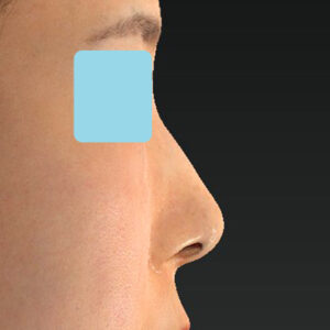 「鼻孔縁下降術」　新宿ラクル美容外科クリニック　山本厚志　３０代女性　手術直後　１月３日