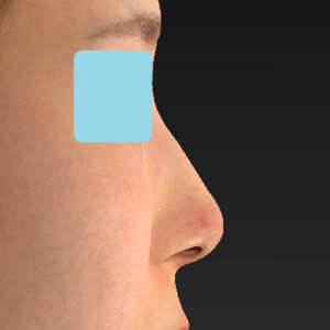 「鼻孔縁下降術」　新宿ラクル美容外科クリニック　山本厚志　３０代女性　手術後１週間目　１月３日