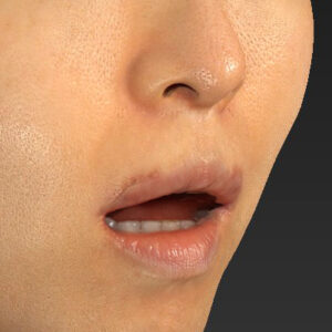 新宿ラクル美容外科クリニック　山本厚志　「外側人中短縮術（上口唇挙上術）修正 + 口角挙上（スマイルリフト）修正」　手術後１ヶ月目　１２月１３日