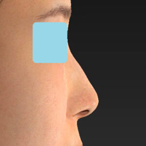 「鼻孔縁下降術」　新宿ラクル美容外科クリニック　山本厚志　３０代女性　手術後１ヶ月目　１月３日