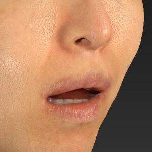 新宿ラクル美容外科クリニック　山本厚志　「外側人中短縮術（上口唇挙上術）修正 + 口角挙上（スマイルリフト）修正」　手術後３ヶ月目　１２月１３日