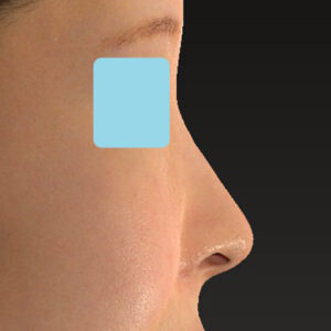 新宿ラクル美容外科クリニック　山本厚志　「小鼻縮小+α法」　手術後３ヶ月目　１月１４日