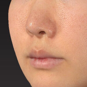 新宿ラクル美容外科クリニック　山本厚志　「猫手術（鼻唇角形成術）+ 貴族手術（鼻翼基部プロテーゼ）」　手術後６ヶ月目　４月５日