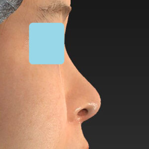 「鼻中隔延長修正＋耳介軟骨移植修正＋鼻尖形成修正＋小鼻縮小＋α法修正＋鼻柱下降＋真皮脂肪移植（鼻尖）」　新宿ラクル美容外科クリニック　２０代女性　手術後６ヶ月目　３月６日