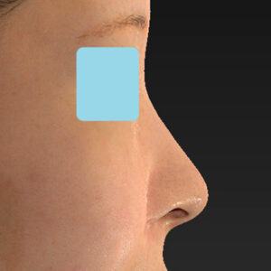 新宿ラクル美容外科クリニック　山本厚志　「小鼻縮小+α法」　手術前　１１月３日