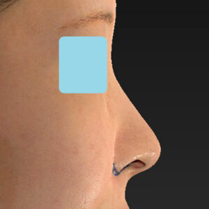 新宿ラクル美容外科クリニック　山本厚志　「小鼻縮小+α法」　デザイン　１１月３日