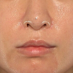 新宿ラクル美容外科クリニック　山本厚志　「外側人中短縮術（上口唇挙上術）修正 + 口角挙上（スマイルリフト）修正」　手術前　１月２２日