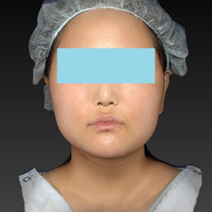 新宿ラクル美容外科クリニック　山本厚志　「ライポライフ脂肪吸引（メーラーファット+ジョールファット+アゴ下）」　手術前　１月２７日