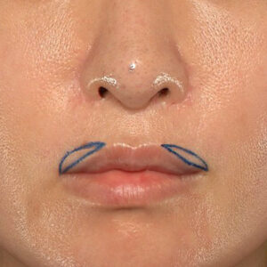 新宿ラクル美容外科クリニック　山本厚志　「外側人中短縮術（上口唇挙上術）修正 + 口角挙上（スマイルリフト）修正」　デザイン　１月２２日