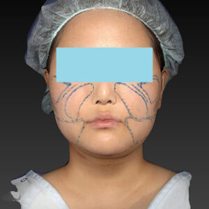 新宿ラクル美容外科クリニック　山本厚志　「ライポライフ脂肪吸引（メーラーファット+ジョールファット+アゴ下）」　デザイン　１月２７日