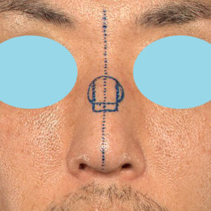 「ワシ鼻修正（ハンプ切除）」　新宿ラクル美容外科クリニック　４０代男性　デザイン　１月１１日