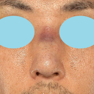 「ワシ鼻修正（ハンプ切除）」　新宿ラクル美容外科クリニック　４０代男性　手術直後　１月１１日