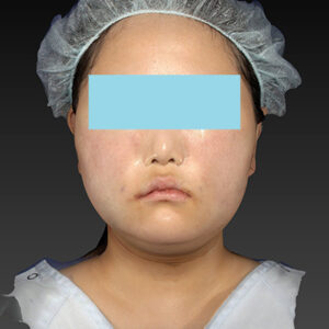 新宿ラクル美容外科クリニック　山本厚志　「ライポライフ脂肪吸引（メーラーファット+ジョールファット+アゴ下）」　手術直後　１月２７日