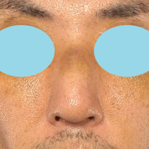 「ワシ鼻修正（ハンプ切除）」　新宿ラクル美容外科クリニック　４０代男性　手術後１週間目　１月１１日