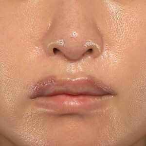 新宿ラクル美容外科クリニック　山本厚志　「外側人中短縮術（上口唇挙上術）修正 + 口角挙上（スマイルリフト）修正」　手術後１週間目　１月２２日