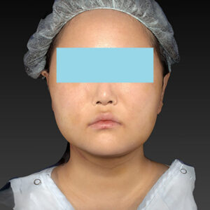 新宿ラクル美容外科クリニック　山本厚志　「ライポライフ脂肪吸引（メーラーファット+ジョールファット+アゴ下）」　手術後１週間目　１月２７日