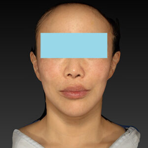 新宿ラクル美容外科クリニック　山本厚志　ナチュラルフェイスネックリフト　手術後１２ヶ月目　２月１５日