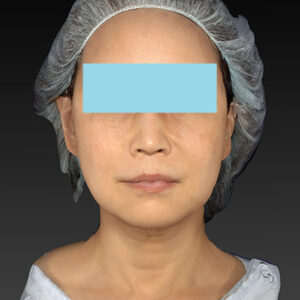 新宿ラクル美容外科クリニック　山本厚志　「アルテミスリフト」　手術後１２ヶ月目　２月２４日