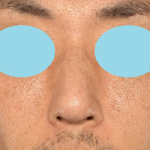 「ワシ鼻修正（ハンプ切除）」　新宿ラクル美容外科クリニック　４０代男性　手術後１ヶ月目　１月１１日