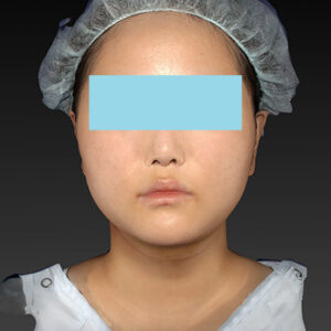 新宿ラクル美容外科クリニック　山本厚志　「ライポライフ脂肪吸引（メーラーファット+ジョールファット+アゴ下）」　手術後１ヶ月目　１月２７日