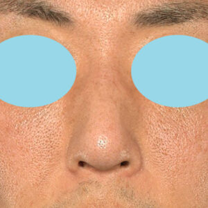 「ワシ鼻修正（ハンプ切除）」　新宿ラクル美容外科クリニック　４０代男性　手術後２ヶ月目　１月１１日