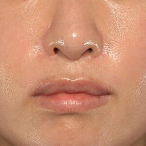 新宿ラクル美容外科クリニック　山本厚志　「外側人中短縮術（上口唇挙上術）修正 + 口角挙上（スマイルリフト）修正」　手術後２ヶ月目　１月２２日