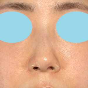 「鼻孔縁下降術」　新宿ラクル美容外科クリニック　山本厚志　３０代女性　手術後２ヶ月目　１月２３日