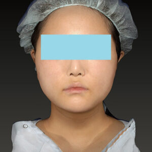 新宿ラクル美容外科クリニック　山本厚志　「ライポライフ脂肪吸引（メーラーファット+ジョールファット+アゴ下）」　手術後２ヶ月目　１月２７日