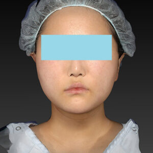 新宿ラクル美容外科クリニック　山本厚志　「ライポライフ脂肪吸引（メーラーファット+ジョールファット+アゴ下）」　手術後３ヶ月目　１月２７日