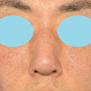 「ワシ鼻修正（ハンプ切除）」　新宿ラクル美容外科クリニック　４０代男性　手術後３ヶ月目　２月１０日