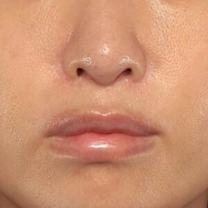 新宿ラクル美容外科クリニック　山本厚志　「外側人中短縮術（上口唇挙上術）修正 + 口角挙上（スマイルリフト）修正」　手術後３ヶ月目　２月１３日