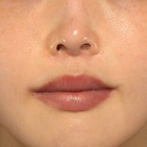 新宿ラクル美容外科クリニック　山本厚志　「人中短縮術（リップリフト）＋口角挙上（スマイルリップ）」　手術後６ヶ月目　３月２６日