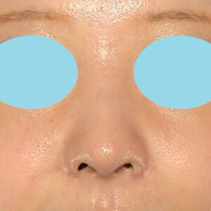 新宿ラクル美容外科クリニック　山本厚志　「小鼻縮小+α法」　手術後６ヶ月目　４月２日