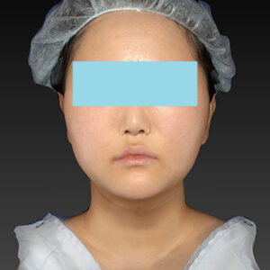 新宿ラクル美容外科クリニック　山本厚志　「ライポライフ脂肪吸引（メーラーファット+ジョールファット+アゴ下）」　手術後６ヶ月目　４月１５日