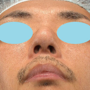 「ワシ鼻修正（ハンプ切除）」　新宿ラクル美容外科クリニック　４０代男性　手術前　１月１１日