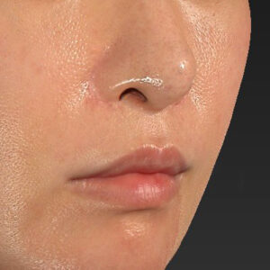 新宿ラクル美容外科クリニック　山本厚志　「外側人中短縮術（上口唇挙上術）修正 + 口角挙上（スマイルリフト）修正」　手術前　１月２２日