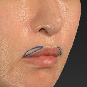 新宿ラクル美容外科クリニック　山本厚志　「外側人中短縮術（上口唇挙上術）修正 + 口角挙上（スマイルリフト）修正」　デザイン　１月２２日