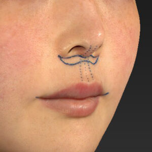 新宿ラクル美容外科クリニック　山本厚志　「人中短縮術（リップリフト）＋口角挙上（スマイルリップ）」　デザイン　１月２９日