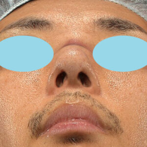 「ワシ鼻修正（ハンプ切除）」　新宿ラクル美容外科クリニック　４０代男性　手術直後　１月１１日