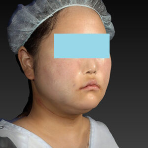 新宿ラクル美容外科クリニック　山本厚志　「ライポライフ脂肪吸引（メーラーファット+ジョールファット+アゴ下）」　手術直後　１月２７日