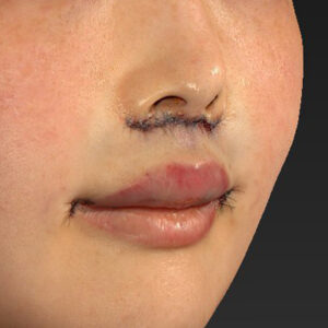 新宿ラクル美容外科クリニック　山本厚志　「人中短縮術（リップリフト）＋口角挙上（スマイルリップ）」　手術直後　１月２９日