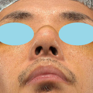 「ワシ鼻修正（ハンプ切除）」　新宿ラクル美容外科クリニック　４０代男性　手術後１週間目　１月１１日