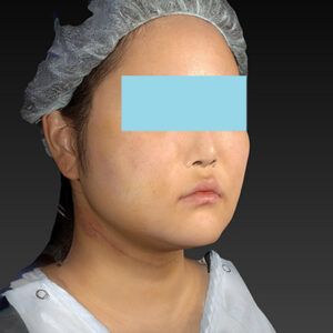 新宿ラクル美容外科クリニック　山本厚志　「ライポライフ脂肪吸引（メーラーファット+ジョールファット+アゴ下）」　手術後１週間目　１月２７日