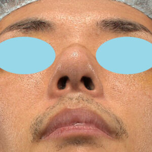 「ワシ鼻修正（ハンプ切除）」　新宿ラクル美容外科クリニック　４０代男性　手術後２週間目　１月１１日