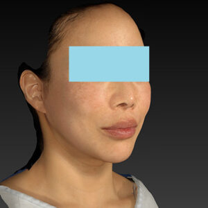 新宿ラクル美容外科クリニック　山本厚志　ナチュラルフェイスネックリフト　手術後１２ヶ月目　２月１５日